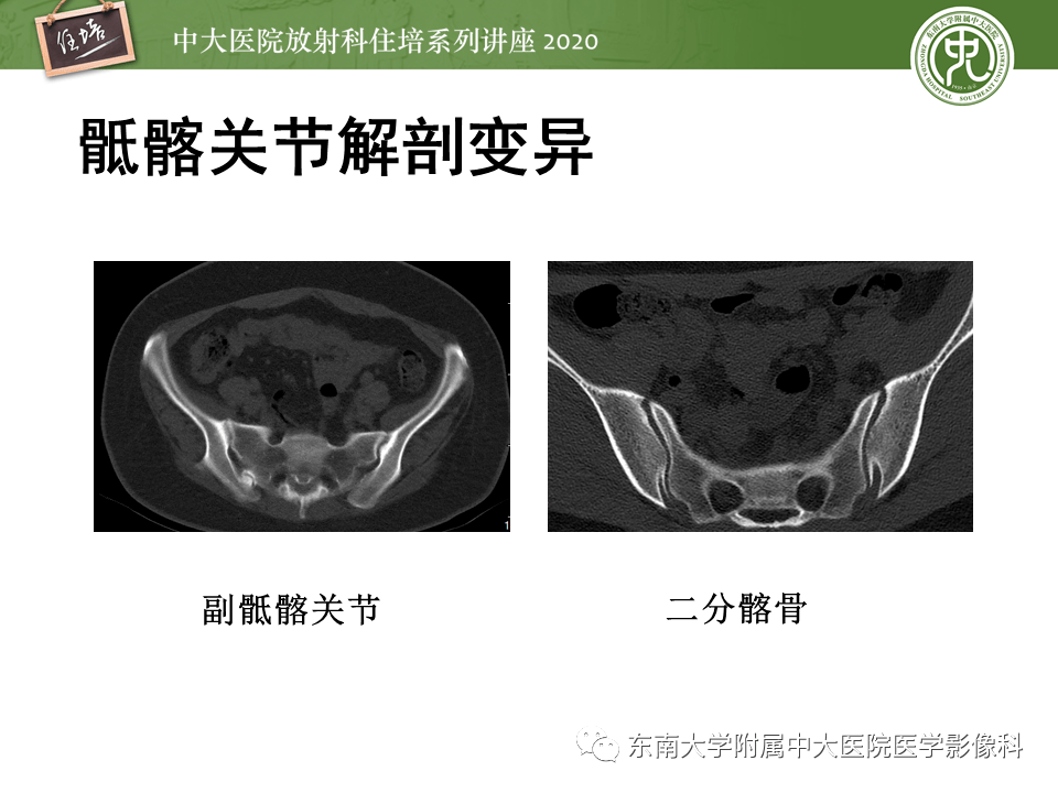 骶髂关节由骶骨与髂骨的耳状关节面相对而构成2021