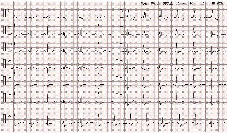 患者女,58歲,圖為其心電圖結論:竇性心律完全性右束支傳導阻滯t波改變