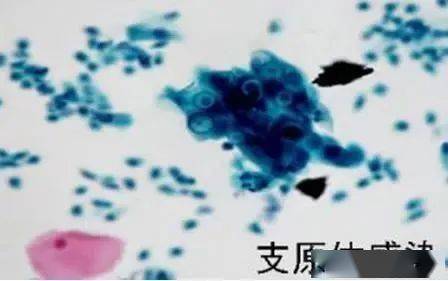 致病|肺炎支原体感染流行高峰期，如何做好预防？济南疾控权威解答