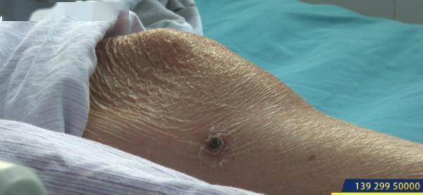 小焦|女子撸猫后住进ICU？警惕这种“小焦痂”，严重可致命