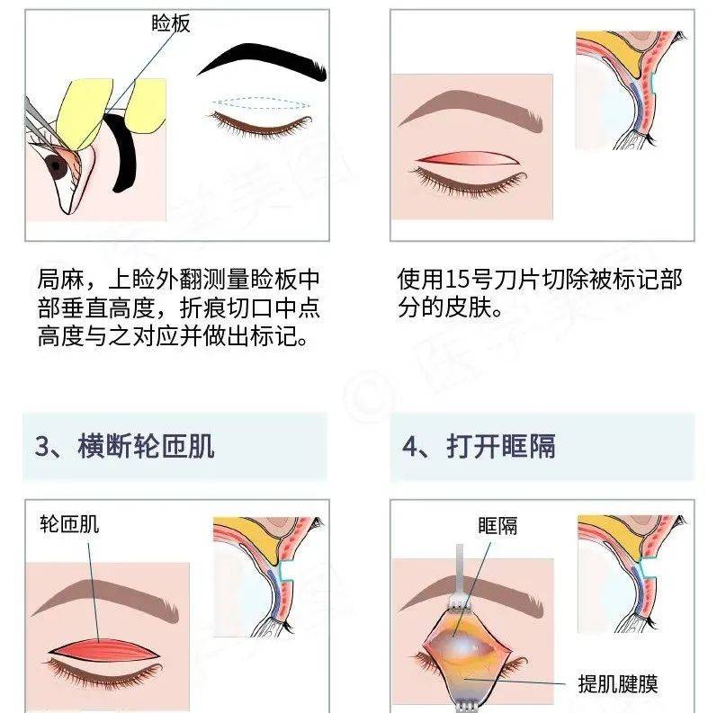 一图读懂丨双眼皮成形术~_成形术_双眼皮