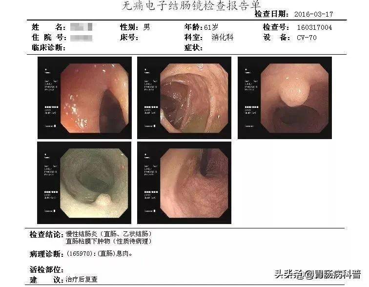 低级别管状腺瘤1级怎么办