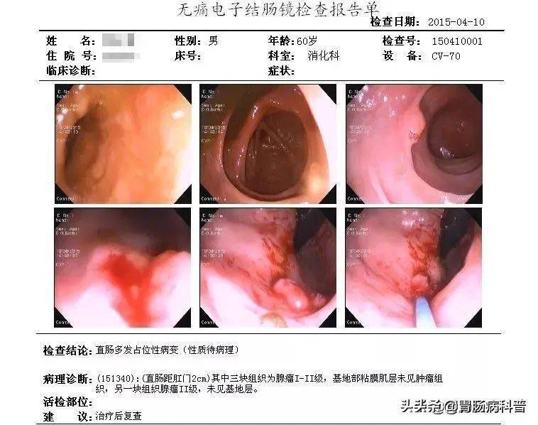 低级别管状腺瘤1级怎么办