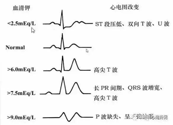 高钾血症心电图改变图片