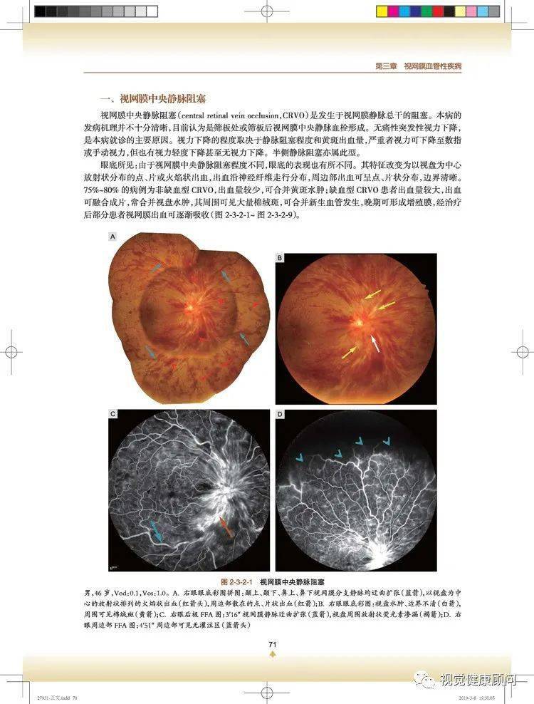 如何理解眼底照片_血管_視網膜_視盤