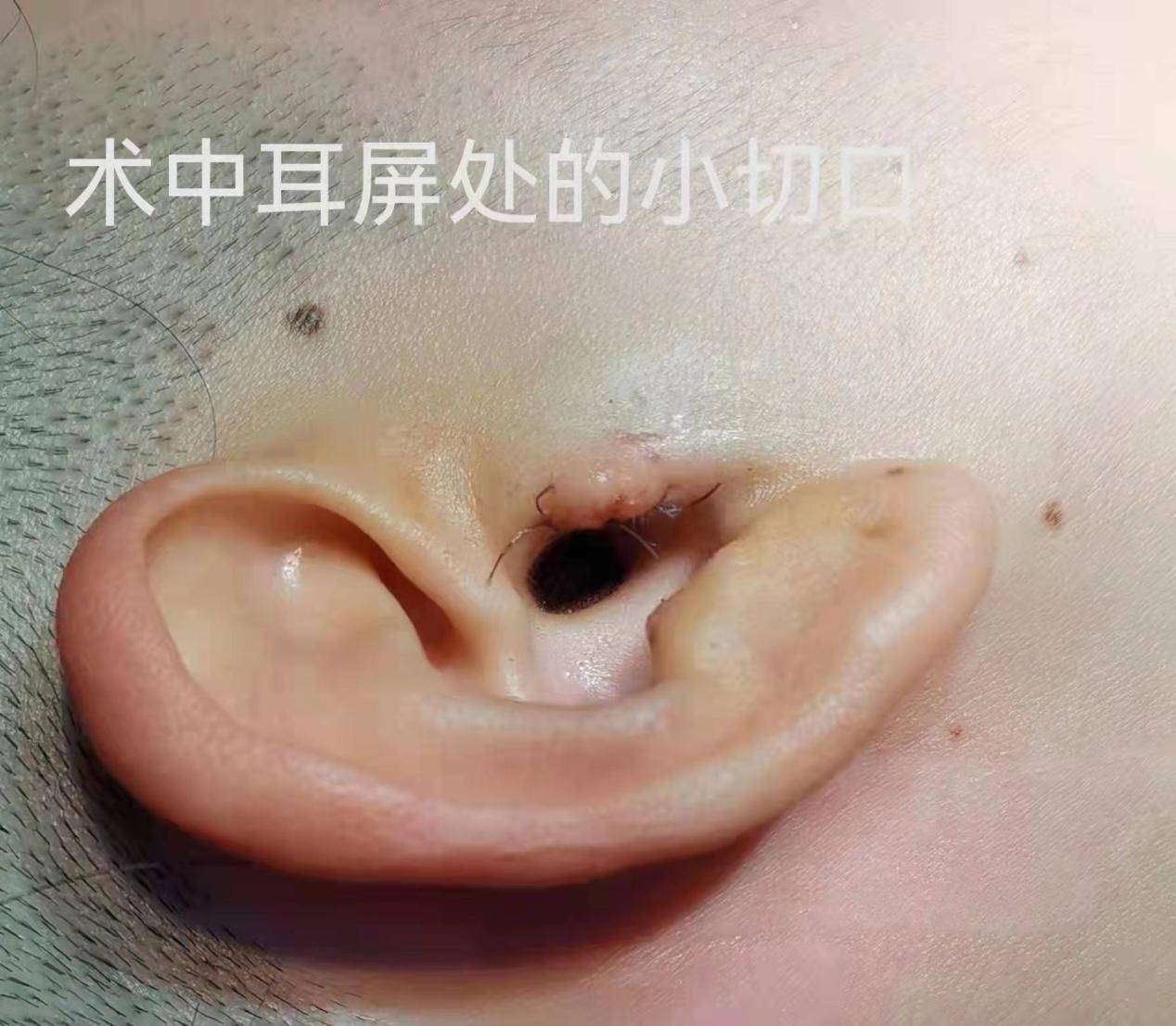 耳膜穿孔手术图片