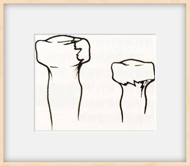 应用最广泛的是mason分型,具体如下:桡骨头骨折分型肘伸直,前臂旋前