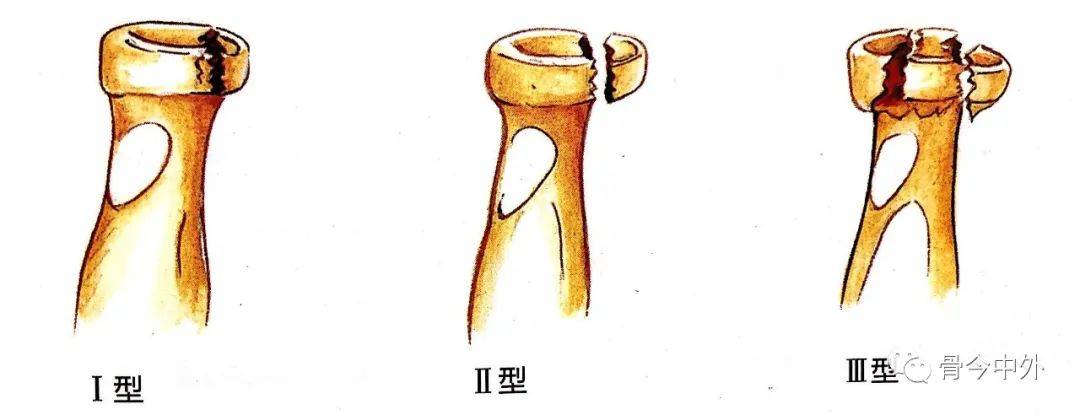 图2:桡骨头骨折mason分型示意图治疗原则
