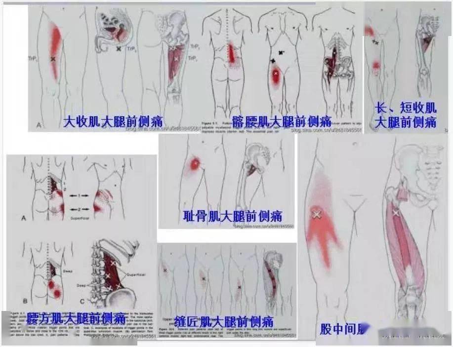 肌筋膜全身160个疼痛触发点