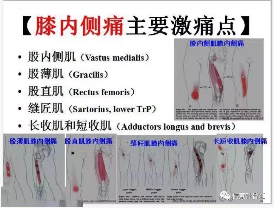 肌筋膜全身160個疼痛觸發點_解剖_臨床_醫學