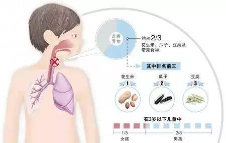 吃饭进入气管怎么办