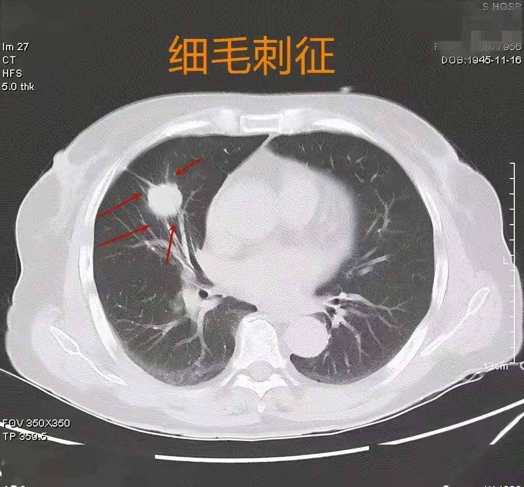 肺結節甲狀腺結節哪種麻煩更大專業解讀一文就能讀懂