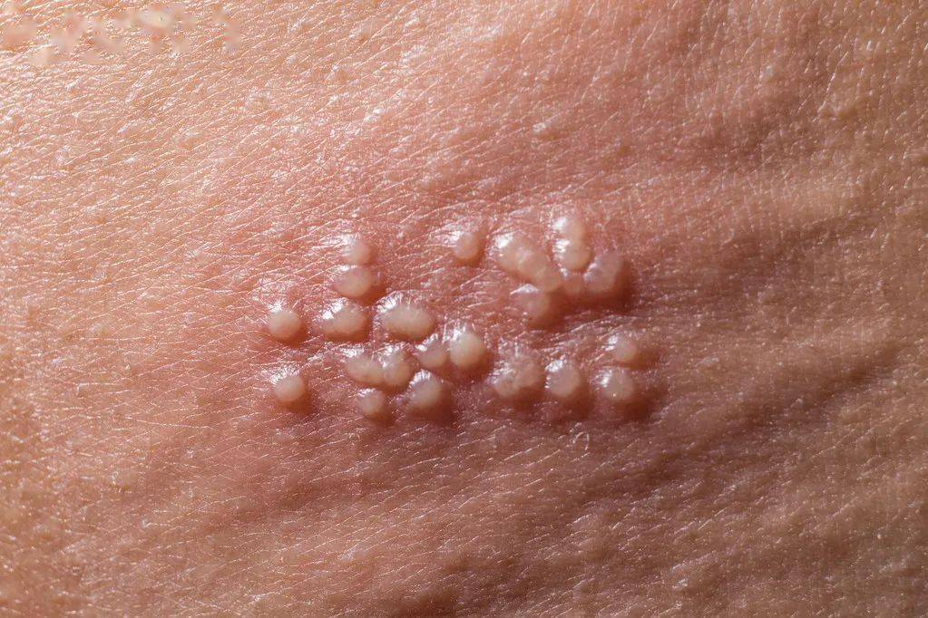 带状疱疹,只需一味草药!_叶子_托叶_基本