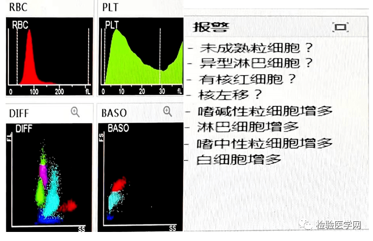 63×10 9 /l,嗜鹼性粒細胞(bas)1.22×10 9 /l,紅細胞(rbc)3.