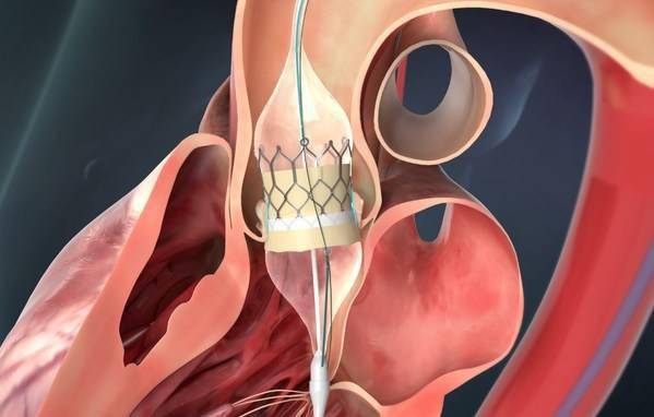 球扩瓣,即球囊扩张瓣膜,有别于自膨式瓣膜,其瓣架较短,在临床应用中