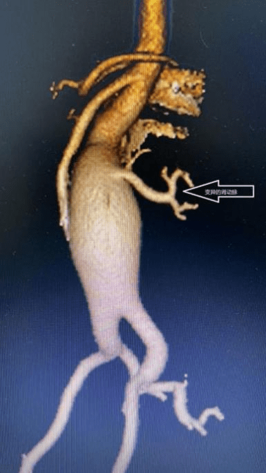 手术|腰痛1个月竟是体内藏瘤？医生“拆弹+肾搬家”切除“炸弹”