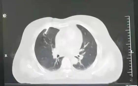 成功|【新闻快递】医院成功实施经皮穿透肋软骨肺穿刺活检术