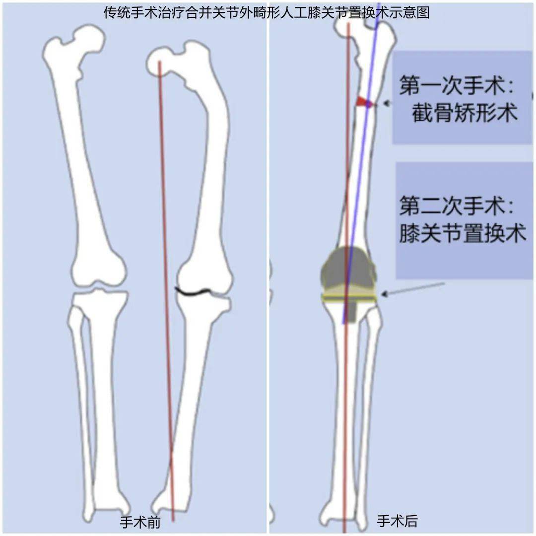 考虑到合并关节外畸形的全膝关节置换术应用常规的手术方案,传统的