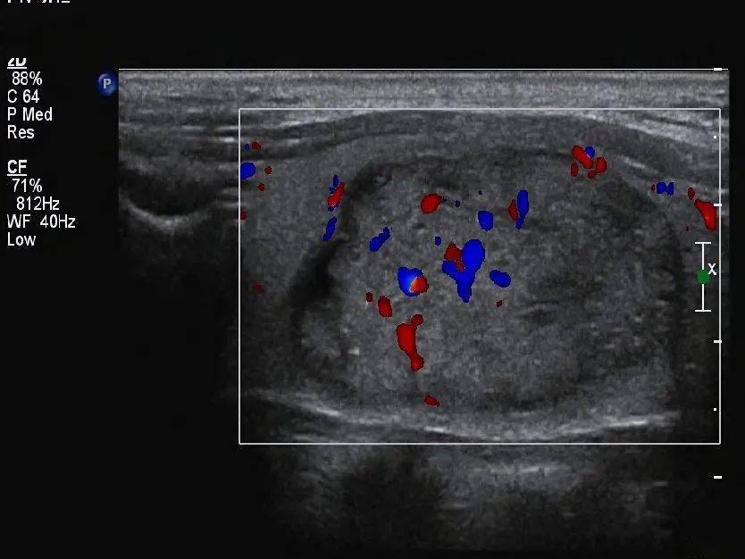 遇到这类甲状腺癌要小心了