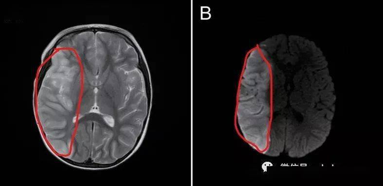 抗体|孩子肺炎支原体感染如何避免被瞎治疗？