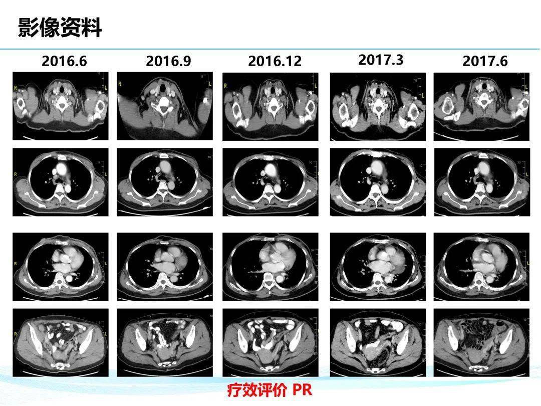 例精图治丨假如不放弃她的pfs可能更长一例her2转移性乳腺癌的治疗