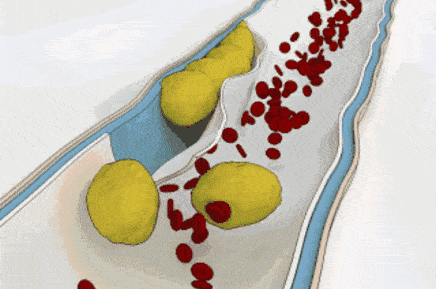 创建老年友善医院 | 血液粘稠有这四个信号,很多人不注意血管就"堵"了