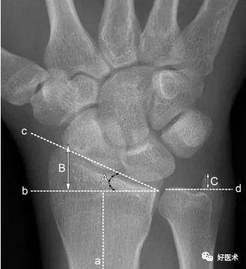 贊腕關節x線高清解剖腕骨脫位典型病例