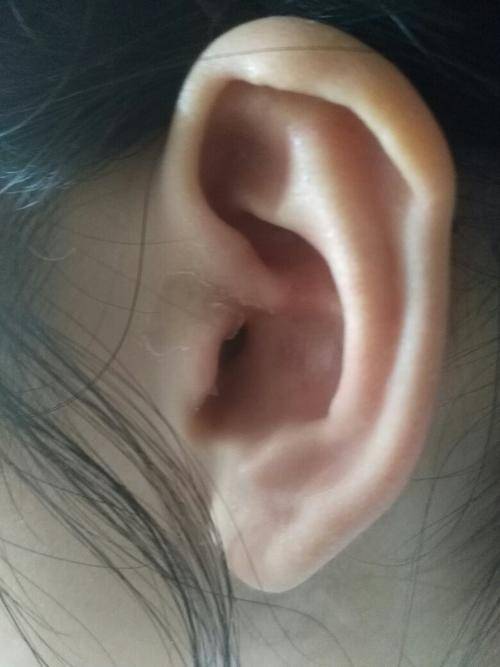 耳垂有褶皱是冠心病信号吗?有依据吗?