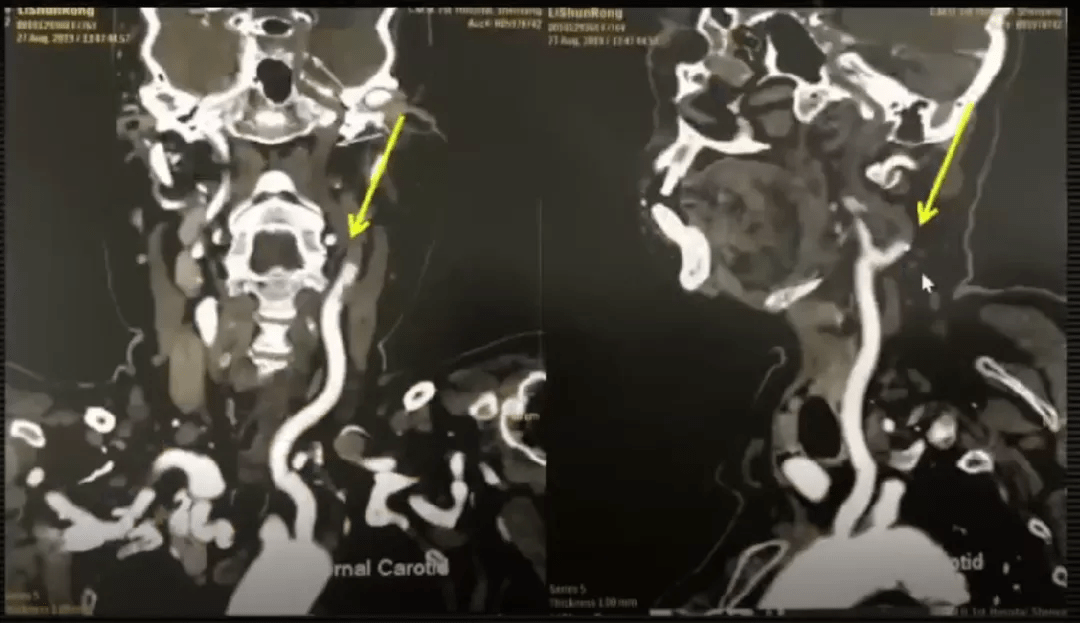 治疗|急性脑梗死MRI的临床特点，超强解读