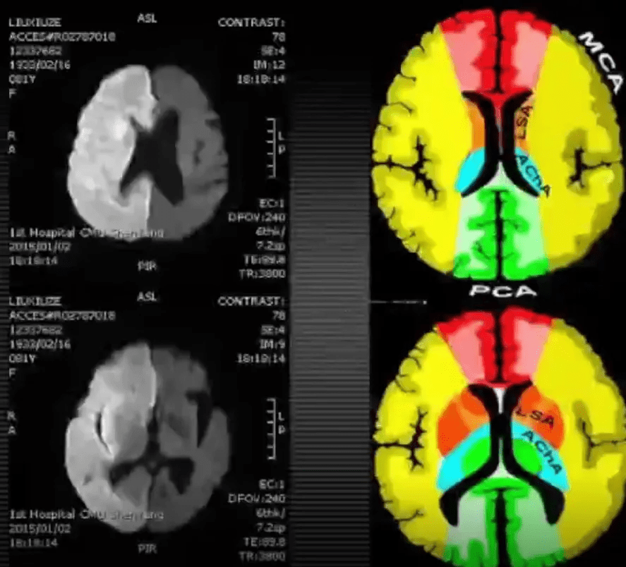 治疗|急性脑梗死MRI的临床特点，超强解读