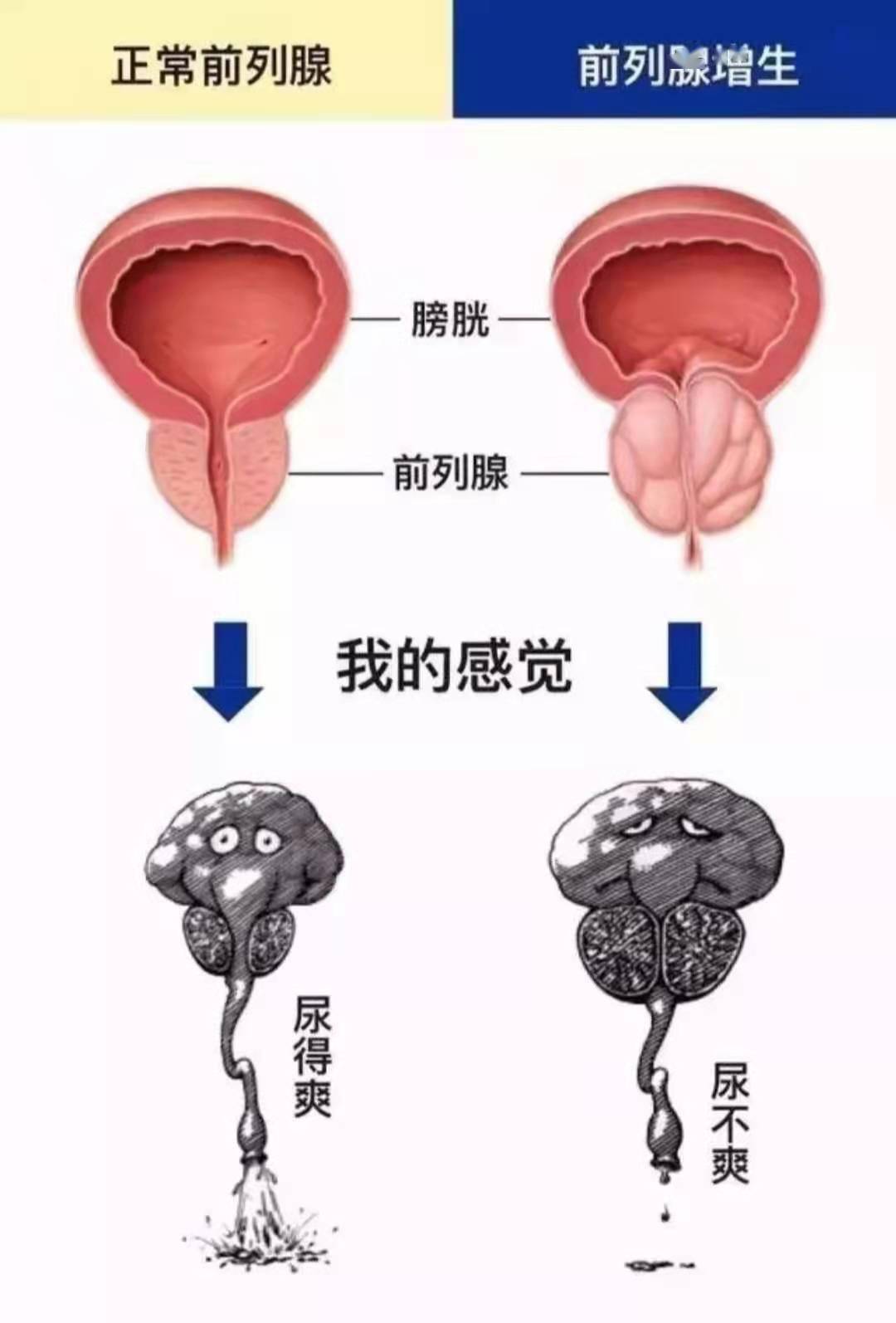 前列腺增生的"苦",懂得都懂!