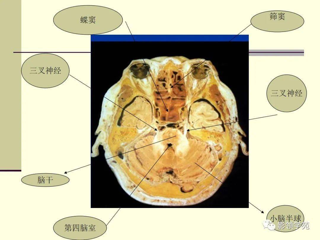 三叉神经mri影像解剖图图片