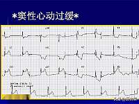 窦性心动过缓，心率＜60次，是病吗？中国标准vs美国标准