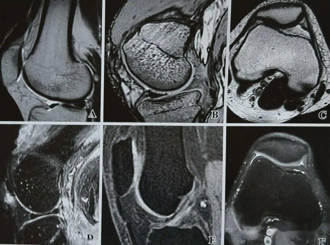 正常膝盖核磁共振图片