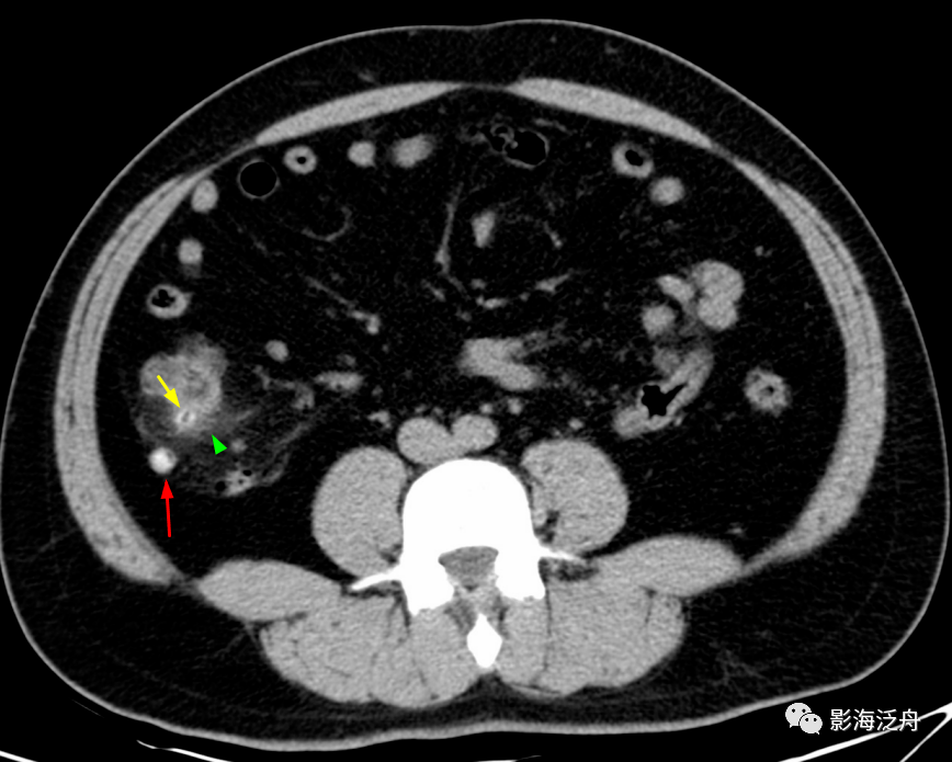 壁厚而强化,近端管腔内见高密度粪石影,注意渗出(绿箭头)以阑尾根部为