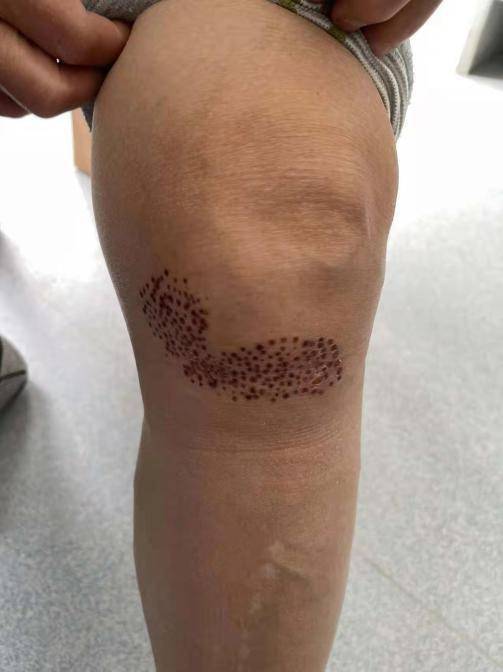 李劼|老寒腿变天就现梅花点，保守治疗或将加重病情