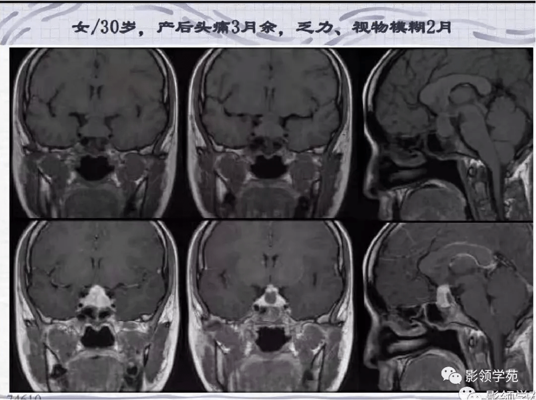 Rathke|垂体解剖及常见病变影像学表现