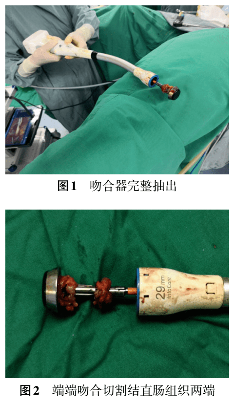 直肠手术吻合器示意图图片