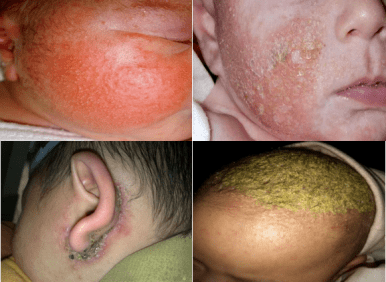 疫线名医科普居家隔离期间宝宝出现皮肤疾病该如何应对上