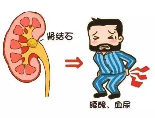 尿酸|【医文医话】外二科：泌尿系小科普之泌尿系结石的预防