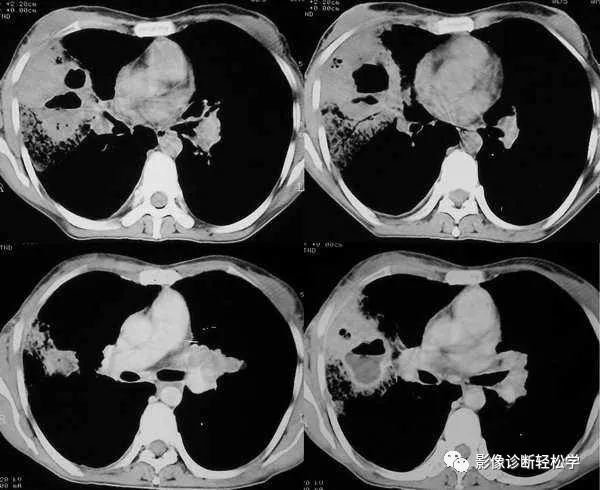 症状|“超低价”种了颗牙，结果住进ICU，肺部啃出无数个洞