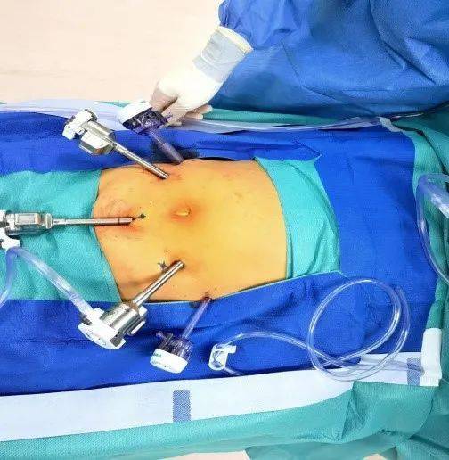 胆胰外科完成佛山市首例达芬奇机器人辅助下胰十二指肠切除手术
