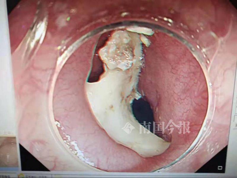 5岁孩子喝粥卡喉，柳州医生从其食道中取出一块长约3cm猪骨头
