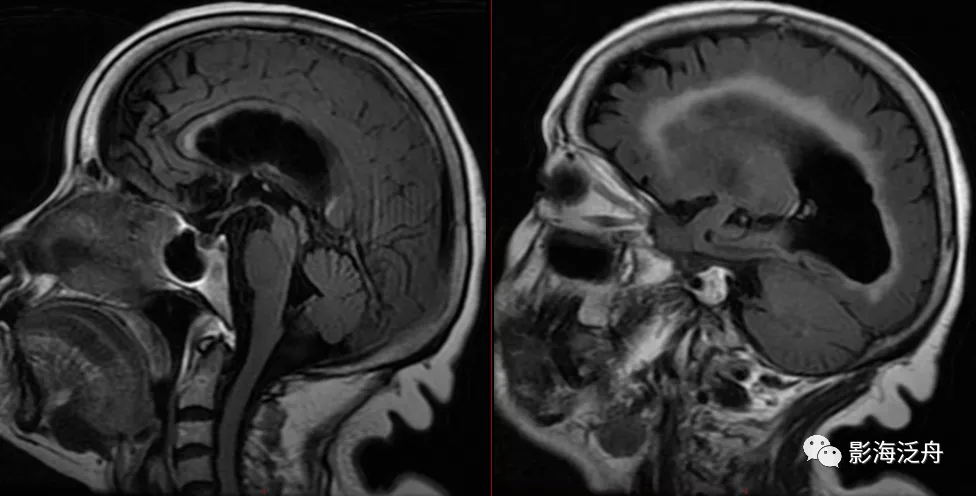 诊断|小心误诊，这可不是单纯的脑萎缩