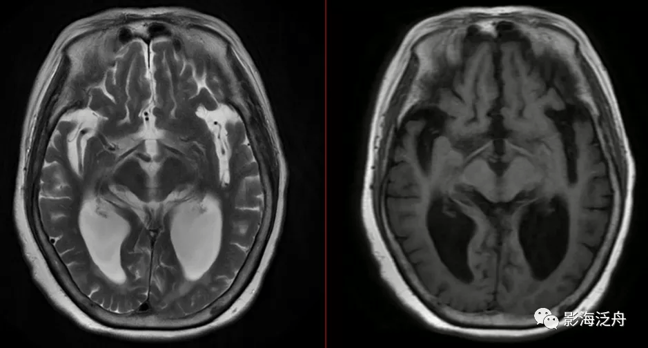 诊断|小心误诊，这可不是单纯的脑萎缩