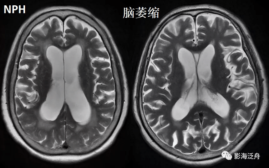 诊断|小心误诊，这可不是单纯的脑萎缩