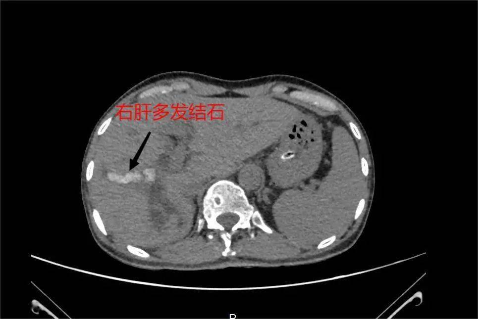 激光|深圳恒生医院利用钬激光碎石术为患者取出数十枚肝内胆管结石