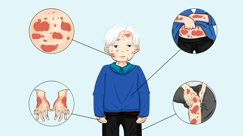 红斑鳞屑瘙痒是银屑病即日起川蜀名医联合坐诊名额有限速约