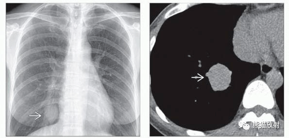 胸部影像诊断图例丨气道病变(良/恶性肿瘤)~