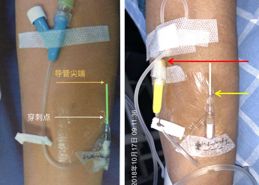 两通留置针（输液的头皮针又叫什么）